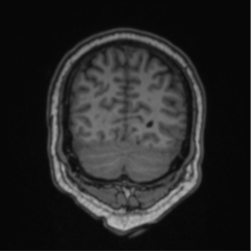 Cerebellar hemangioblastomas and pituitary adenoma (Radiopaedia 85490-101176 Coronal T1 23).png