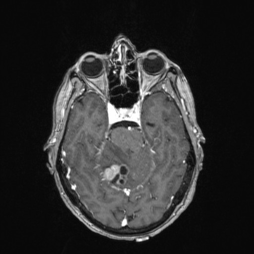 File:Cerebellar metastases (Radiopaedia 24038-24249 Axial T1 C+ 27).jpg