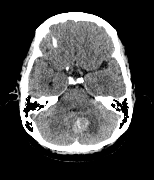 Cerebellar metastases - colorectal adenocarcinoma (Radiopaedia 40947-43652 Axial non-contrast 18).png