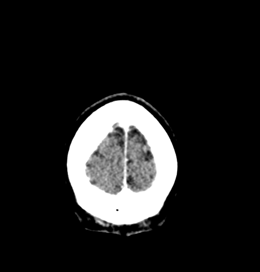 Cerebellar metastases - colorectal adenocarcinoma (Radiopaedia 40947-43652 Coronal C+ 11).png