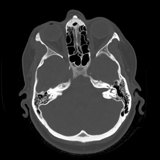 File:Cerebellar metastasis (cystic appearance) (Radiopaedia 41395-44258 Axial bone window 17).png
