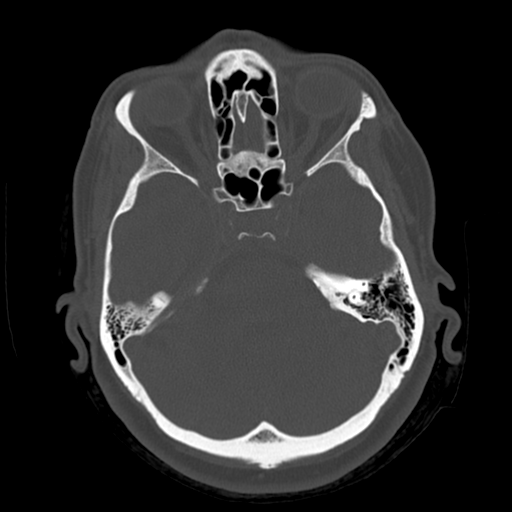 Cerebellar metastasis (cystic appearance) (Radiopaedia 41395-44258 Axial bone window 19).png