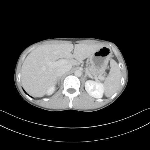 Cerebellar metastasis - adenocarcinoma lung (Radiopaedia 63184-71717 Axial C+ delayed 69).png