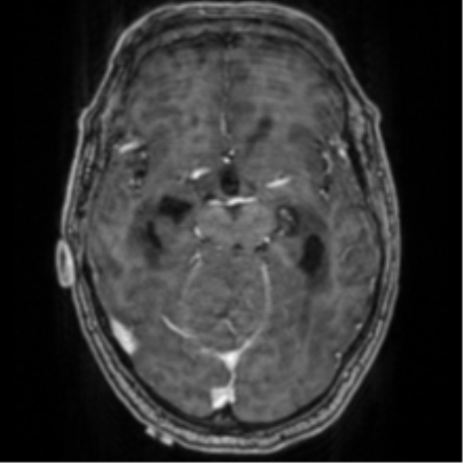 File:Cerebellar metastasis from lung adenocarcinoma (Radiopaedia 86690-102829 Axial T1 C+ 34).png