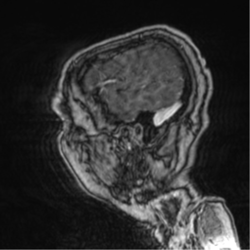 Cerebellar metastasis from lung adenocarcinoma (Radiopaedia 86690-102829 Sagittal T1 C+ 70).png