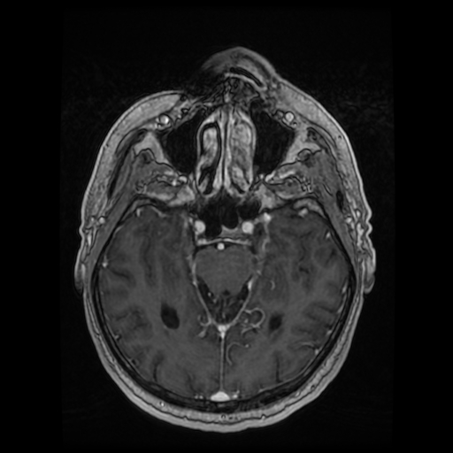 Cerebellar metastasis of pulmonary adenocarcinoma, cavernous venous malformation, and developmental venous anomaly (Radiopaedia 85827-101661 Axial T1 C+ 39).jpg