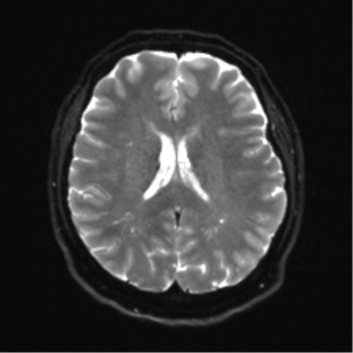 Cerebellopontine angle meningioma (Radiopaedia 48434-53348 Axial DWI 24).png
