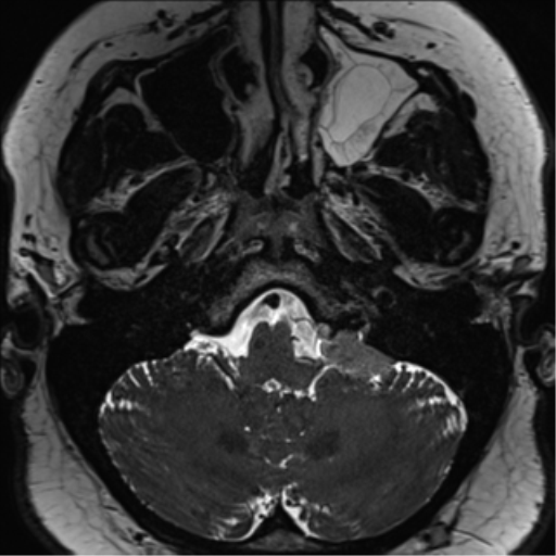 Cerebellopontine angle meningioma (Radiopaedia 48434-53348 Axial T2 Space 38).png