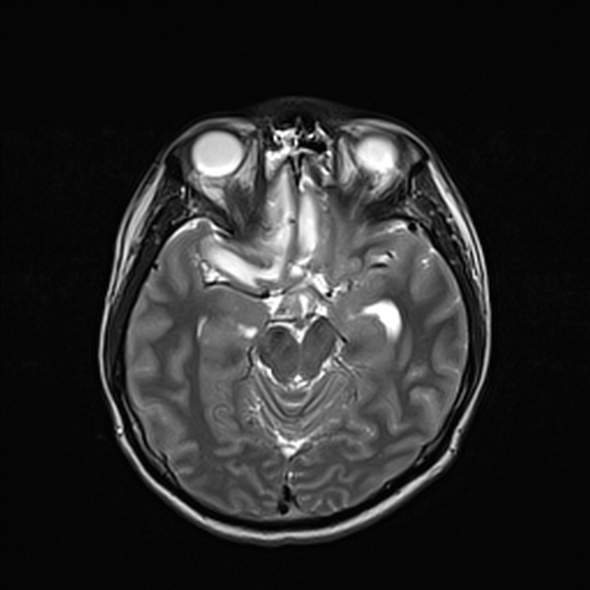 File:Cerebral abscess (Radiopaedia 24212-24478 Axial T2 26).jpg