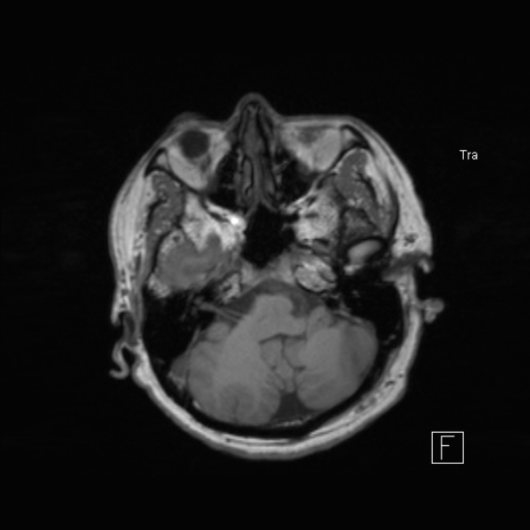 Cerebral abscess (Radiopaedia 26111-26247 Axial T1 20).jpg