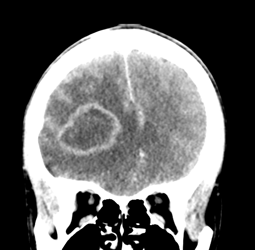 Cerebral abscess (Radiopaedia 60342-68008 Coronal C+ delayed 20).png