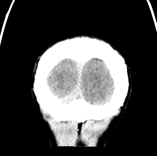 Cerebral abscess (Radiopaedia 60342-68008 Coronal non-contrast 60).png
