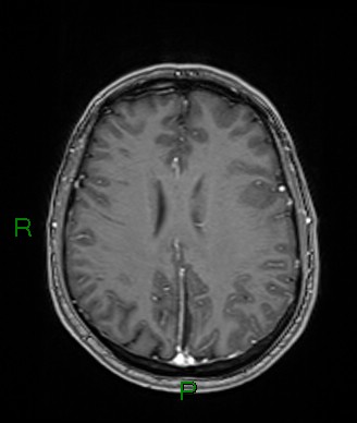 Cerebral abscess and subdural empyema (Radiopaedia 84436-99779 Axial T1 C+ 33).jpg