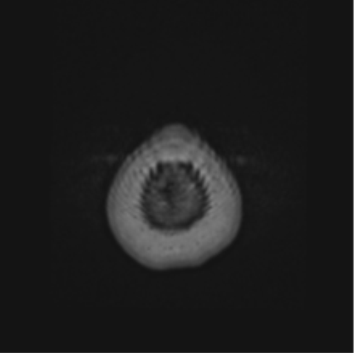 File:Cerebral abscess from pulmonary arteriovenous malformation (Radiopaedia 86275-102291 J 74).png