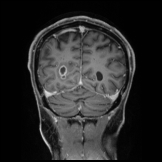 Cerebral abscess with ventriculitis (Radiopaedia 78965-91878 Coronal T1 C+ 50).jpg