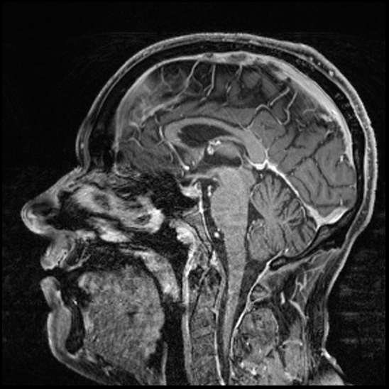 Cerebral abscess with ventriculitis (Radiopaedia 78965-91878 Sagittal T1 C+ 94).jpg