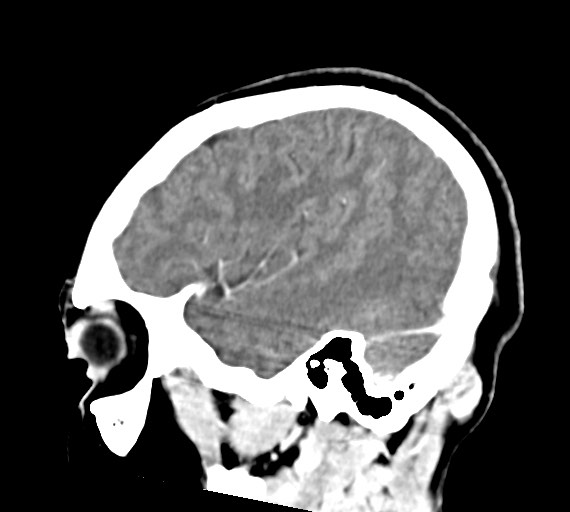 Cerebral abscesses (Radiopaedia 70458-80568 Sagittal Contrast 43).jpg
