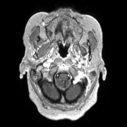 Cerebral amyloid angiopathy (Radiopaedia 29129-29518 Axial T1 C+ 20).jpg