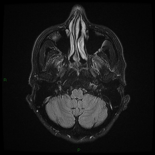 File:Cerebral amyloid angiopathy (Radiopaedia 77506-89664 Axial FLAIR 6).jpg