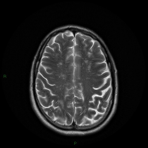 File:Cerebral amyloid angiopathy (Radiopaedia 77506-89664 Axial T2 21).jpg