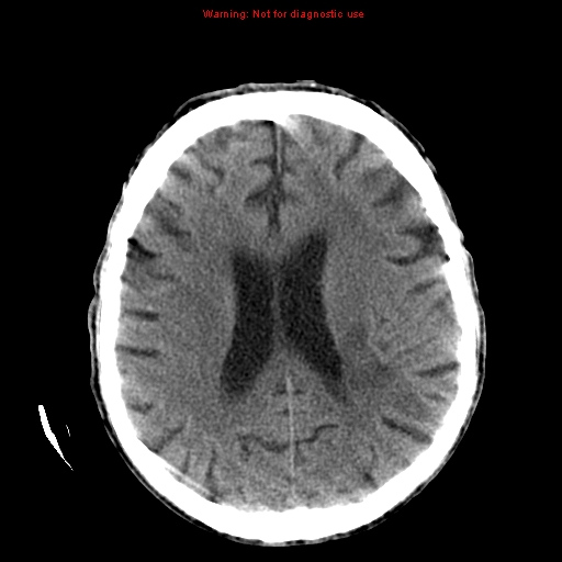 File:Cerebral and orbital tuberculomas (Radiopaedia 13308-13310 Axial non-contrast 18).jpg