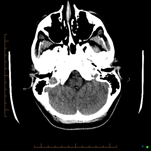 Cerebral arteriovenous malformation (AVM) (Radiopaedia 78162-90706 Axial non-contrast 14).jpg