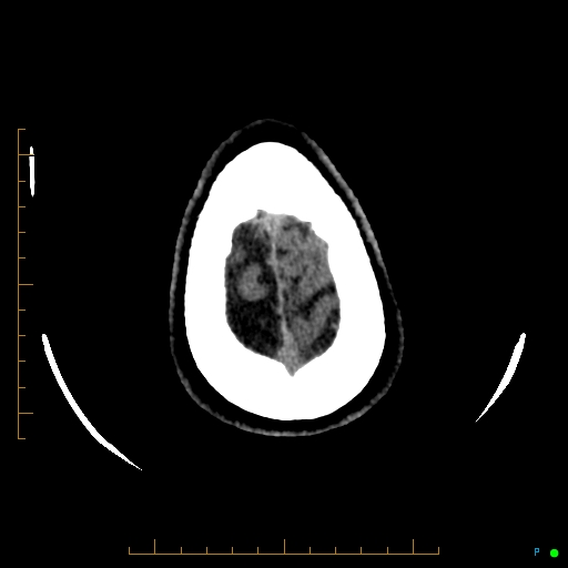 Cerebral arteriovenous malformation (AVM) (Radiopaedia 78162-90706 Axial non-contrast 60).jpg