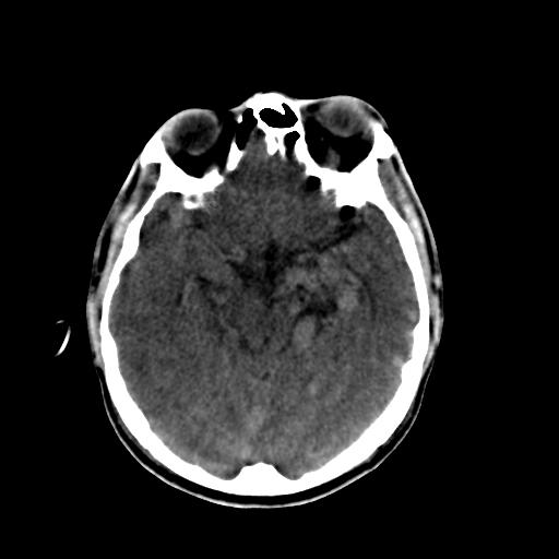 Cerebral arteriovenous malformation (Radiopaedia 28518-28759 Axial non-contrast 28).jpg