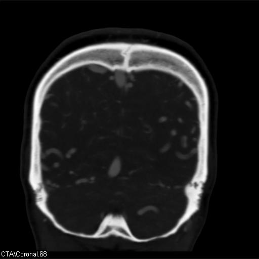 Cerebral arteriovenous malformation (Radiopaedia 28518-28759 C 68).jpg