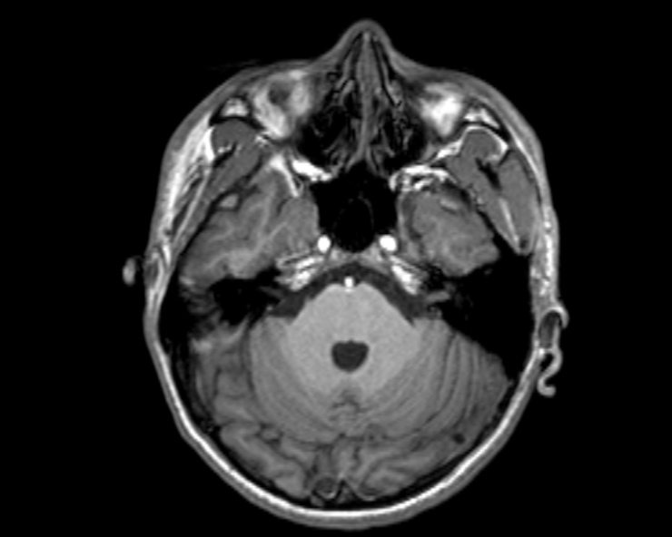 Cerebral arteriovenous malformation (Radiopaedia 30198-30813 Axial T1 43).jpg