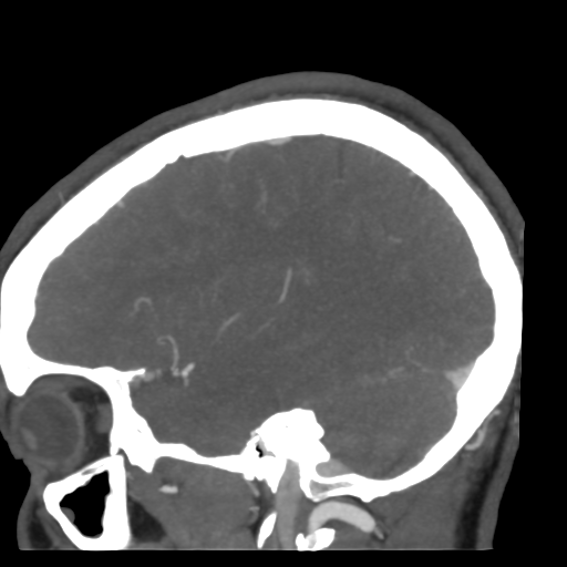 Cerebral arteriovenous malformation (Radiopaedia 39259-41505 Sagittal 45).png