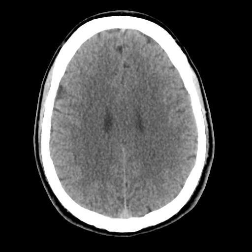File:Cerebral arteriovenous malformation (Radiopaedia 55798-62371 Axial non-contrast 37).png