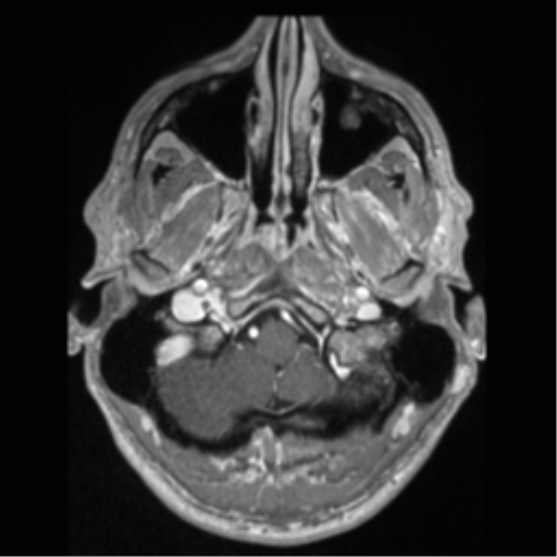 File:Cerebral arteriovenous malformation (Radiopaedia 55798-62372 Axial T1 C+ 8).png