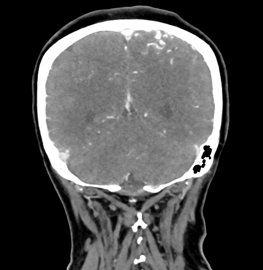 Cerebral arteriovenous malformation (Radiopaedia 73830-84645 C 73).jpg