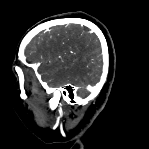 Cerebral arteriovenous malformation (Radiopaedia 73830-84645 Sagittal C+ delayed 17).jpg