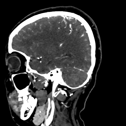Cerebral arteriovenous malformation (Radiopaedia 73830-84645 Sagittal C+ delayed 66).jpg