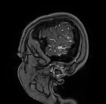 Cerebral arteriovenous malformation (Radiopaedia 74411-85654 Sagittal T1 C+ 7).jpg