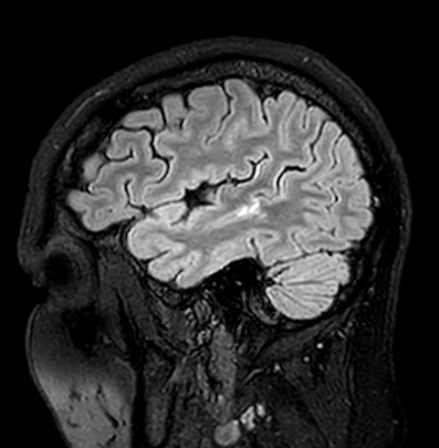 Cerebral arteriovenous malformation (Radiopaedia 74411-85746 Sagittal FLAIR 19).jpg