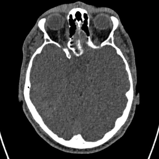 Cerebral arteriovenous malformation (Radiopaedia 78188-90746 Axial non-contrast 63).jpg