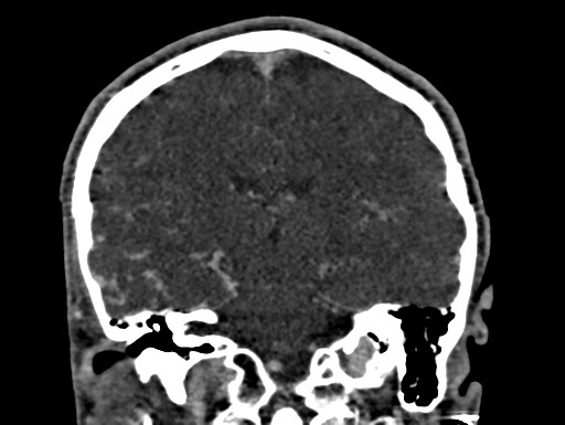 Cerebral arteriovenous malformation (Radiopaedia 78188-90746 Coronal C+ delayed 69).jpg