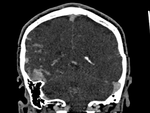 Cerebral arteriovenous malformation (Radiopaedia 78188-90746 Coronal C+ delayed 84).jpg