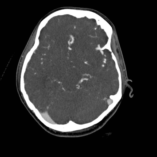 File:Cerebral arteriovenous malformation (Radiopaedia 79677-92888 A 20).jpg