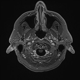 Cerebral arteriovenous malformation (Radiopaedia 84015-99245 Axial T1 C+ 18).jpg