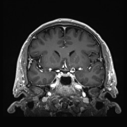 Cerebral arteriovenous malformation (Radiopaedia 84015-99245 Coronal T1 C+ 65).jpg