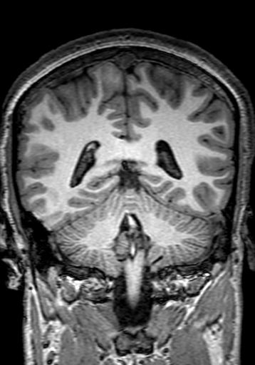 Cerebral arteriovenous malformation at posterior body of corpus callosum (Radiopaedia 74111-84925 Coronal T1 231).jpg