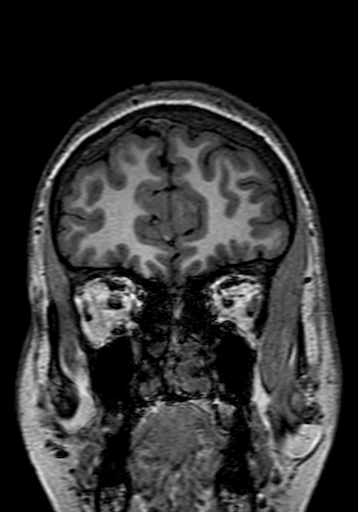 Cerebral arteriovenous malformation at posterior body of corpus callosum (Radiopaedia 74111-84925 Coronal T1 41).jpg