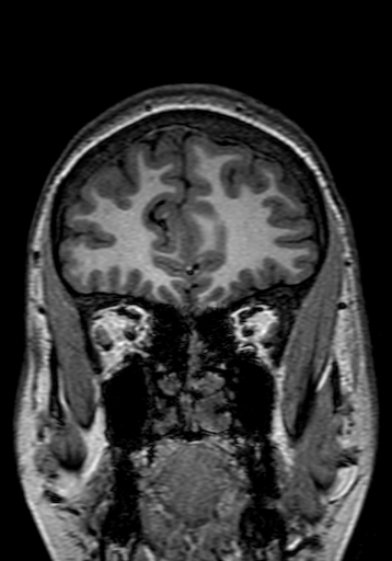 Cerebral arteriovenous malformation at posterior body of corpus callosum (Radiopaedia 74111-84925 Coronal T1 49).jpg