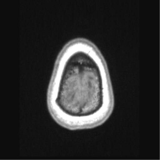 File:Cerebral arteriovenous malformation with hemorrhage (Radiopaedia 34422-35737 Axial T1 73).png