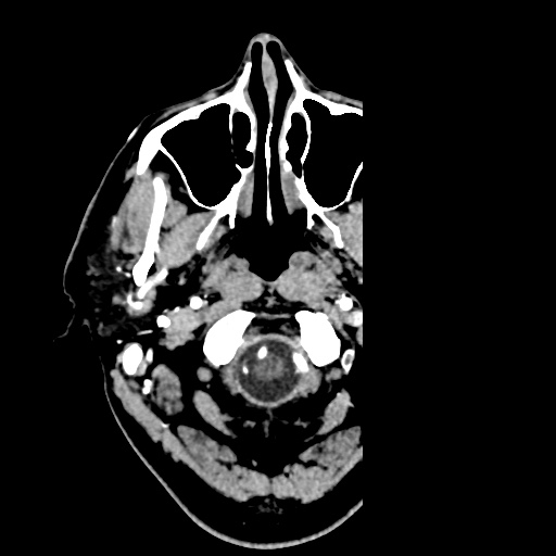 File:Cerebral arteriovenous malformation with lobar hemorrhage (Radiopaedia 35598-57216 A 2).jpg