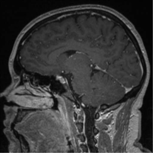 Cerebral cavernoma and development venous anomaly (Radiopaedia 37603-39482 Sagittal T1 C+ 53).png